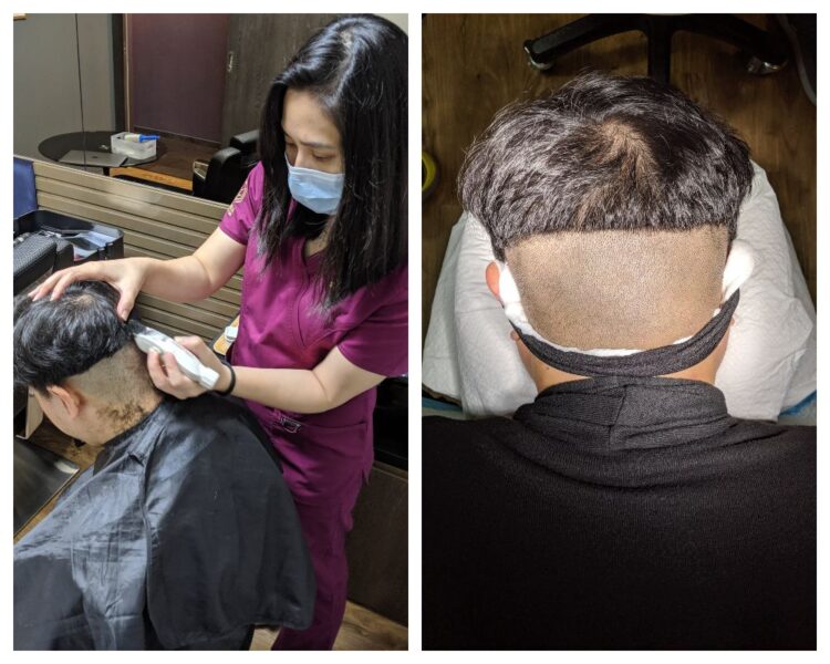 hair transplant singapore 5