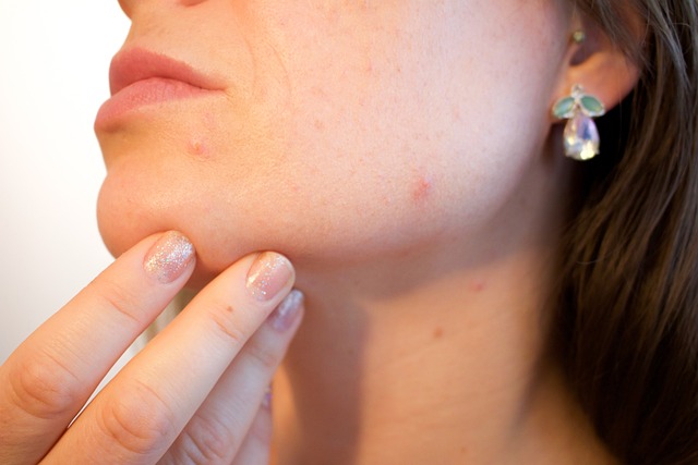 showing acne and pores
