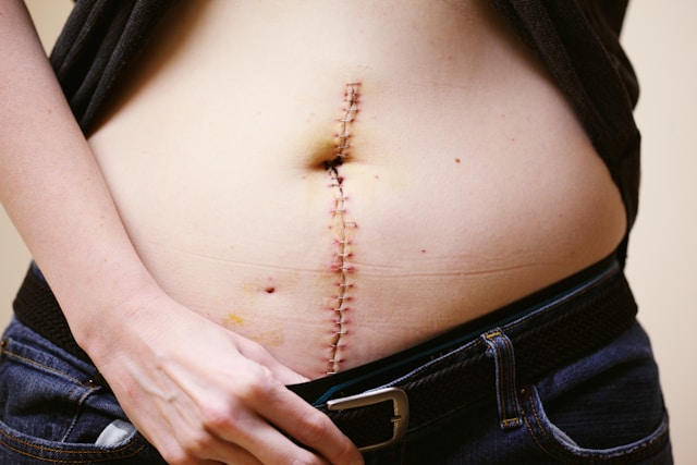 staples and scar from right hemicolectomy